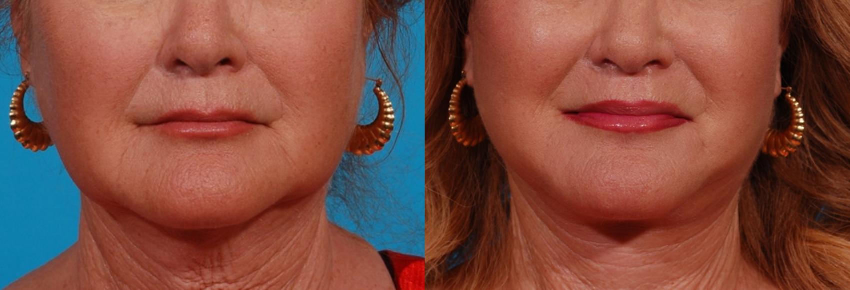 Ellacor Case 166 Before & After Front | Tucson, AZ | Foothills Facial Plastic Surgery
