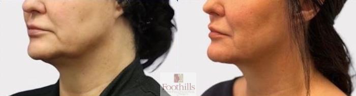 Ellacor Case 167 Before & After Left Oblique | Tucson, AZ | Foothills Facial Plastic Surgery
