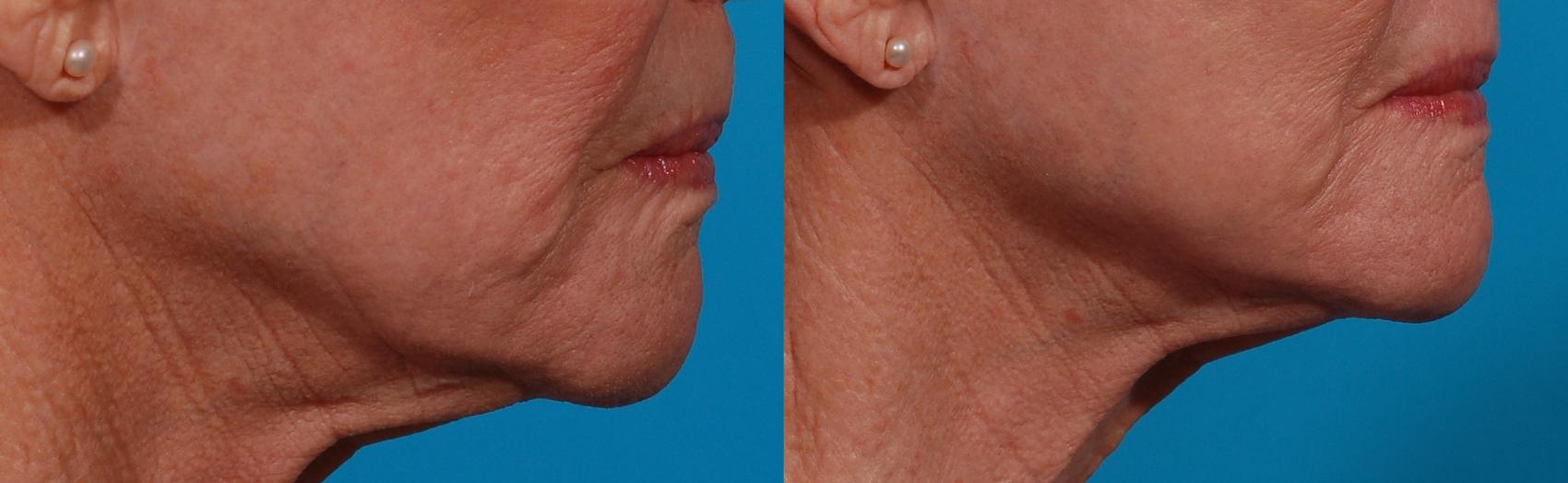 Ellacor Case 174 Before & After Right Side | Tucson, AZ | Foothills Facial Plastic Surgery
