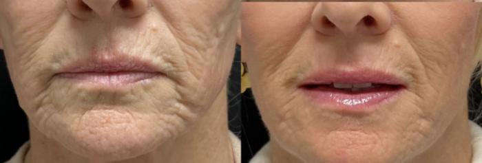 Ellacor Case 177 Before & After Front | Tucson, AZ | Foothills Facial Plastic Surgery