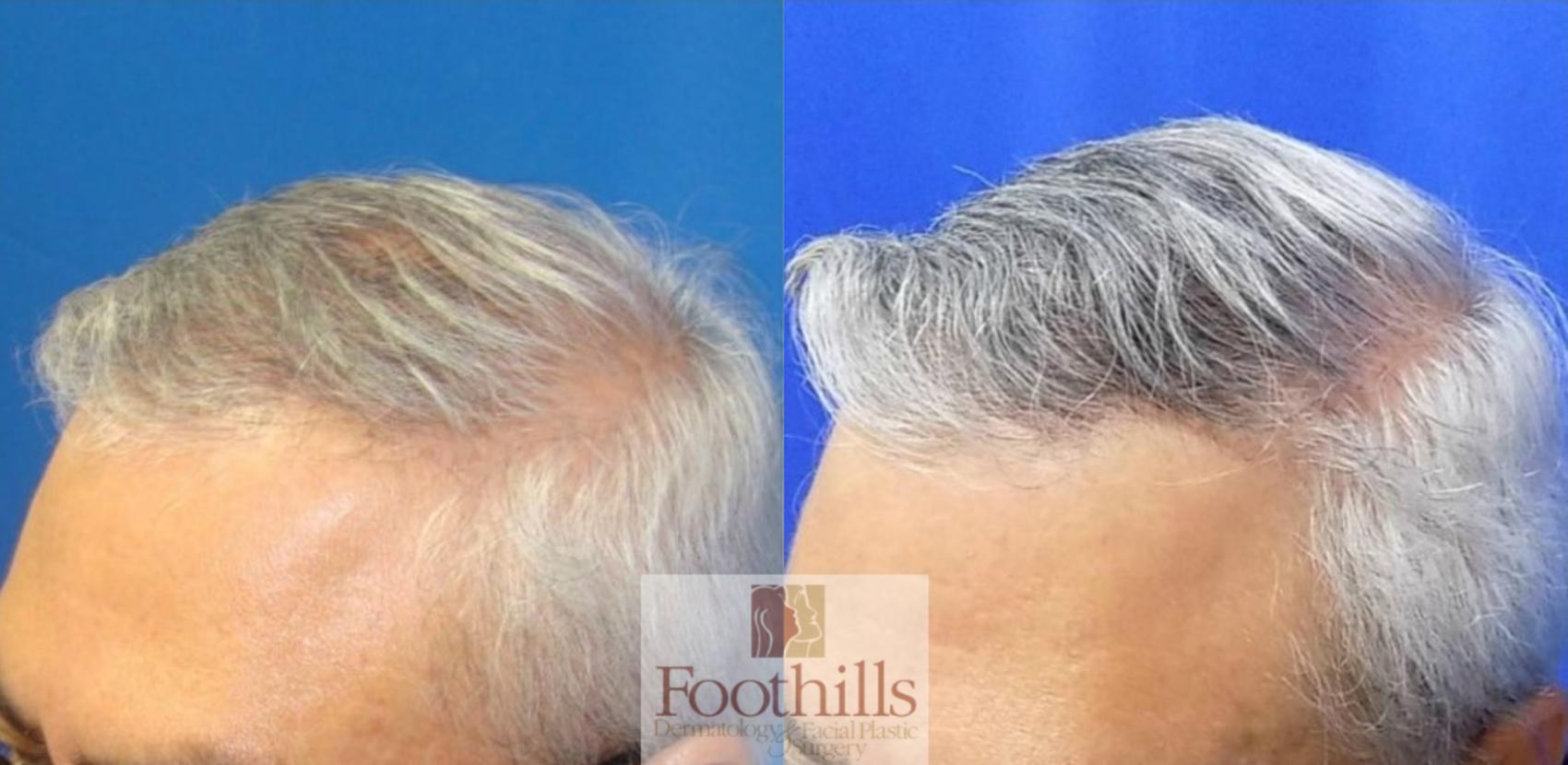 Exosomes Case 194 Before & After Left Oblique | Tucson, AZ | Foothills Facial Plastic Surgery