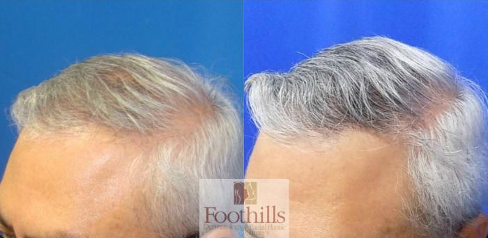 Exosomes Case 194 Before & After Left Oblique | Tucson, AZ | Foothills Facial Plastic Surgery