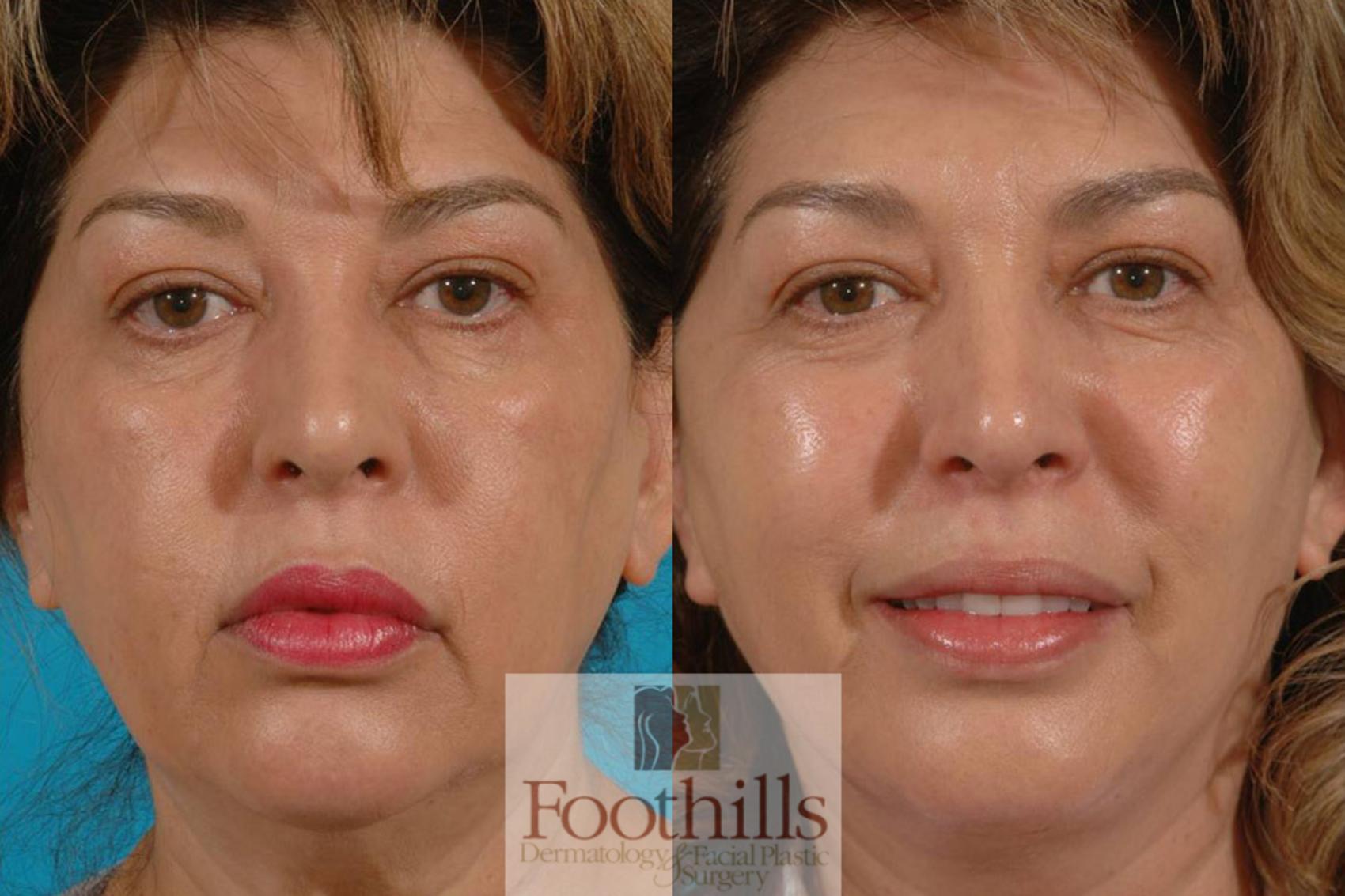 Facelift Case 1 Before & After View #1 | Tucson, AZ | Foothills Facial Plastic Surgery