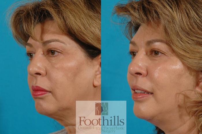 Facelift Case 1 Before & After View #2 | Tucson, AZ | Foothills Facial Plastic Surgery