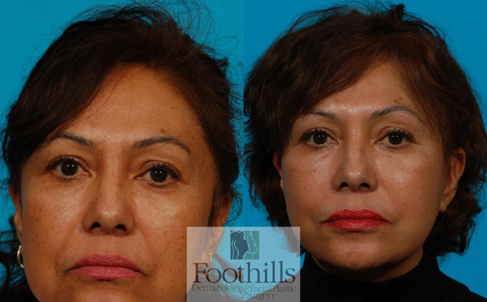 Facelift Case 116 Before & After View #1 | Tucson, AZ | Foothills Facial Plastic Surgery