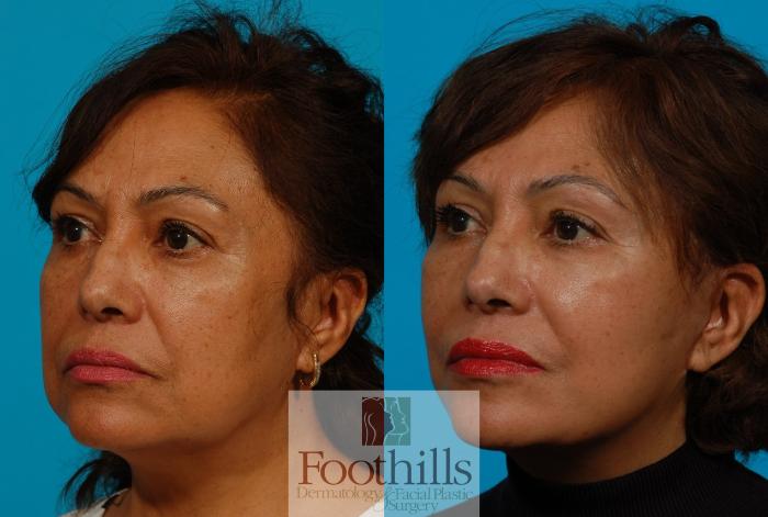 Facelift Case 116 Before & After View #2 | Tucson, AZ | Foothills Facial Plastic Surgery