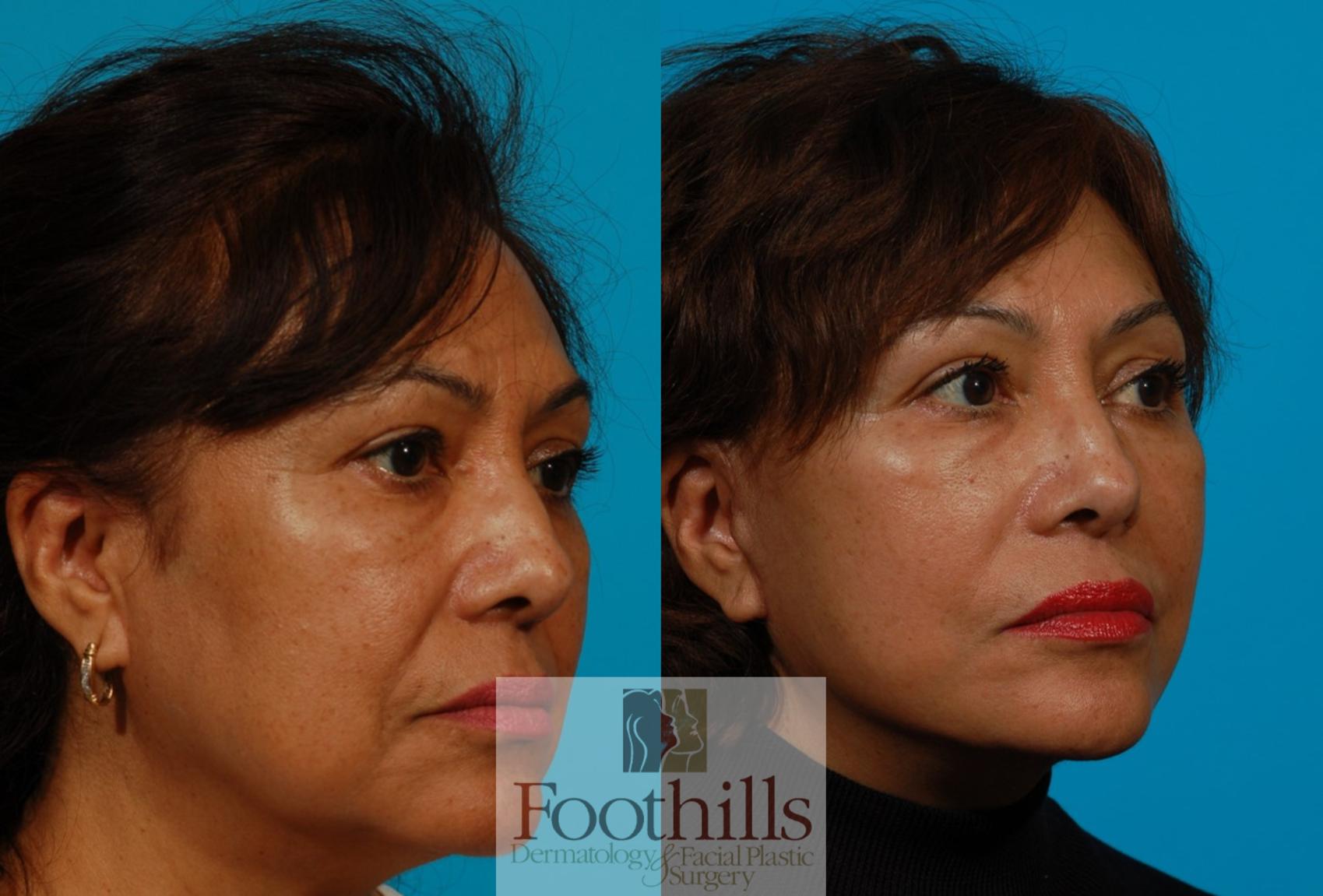 Facelift Case 116 Before & After View #3 | Tucson, AZ | Foothills Facial Plastic Surgery