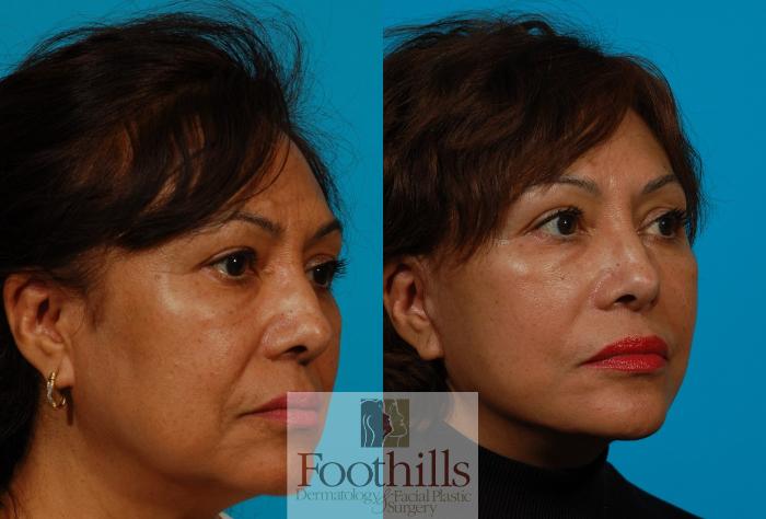 Facelift Case 116 Before & After View #3 | Tucson, AZ | Foothills Facial Plastic Surgery