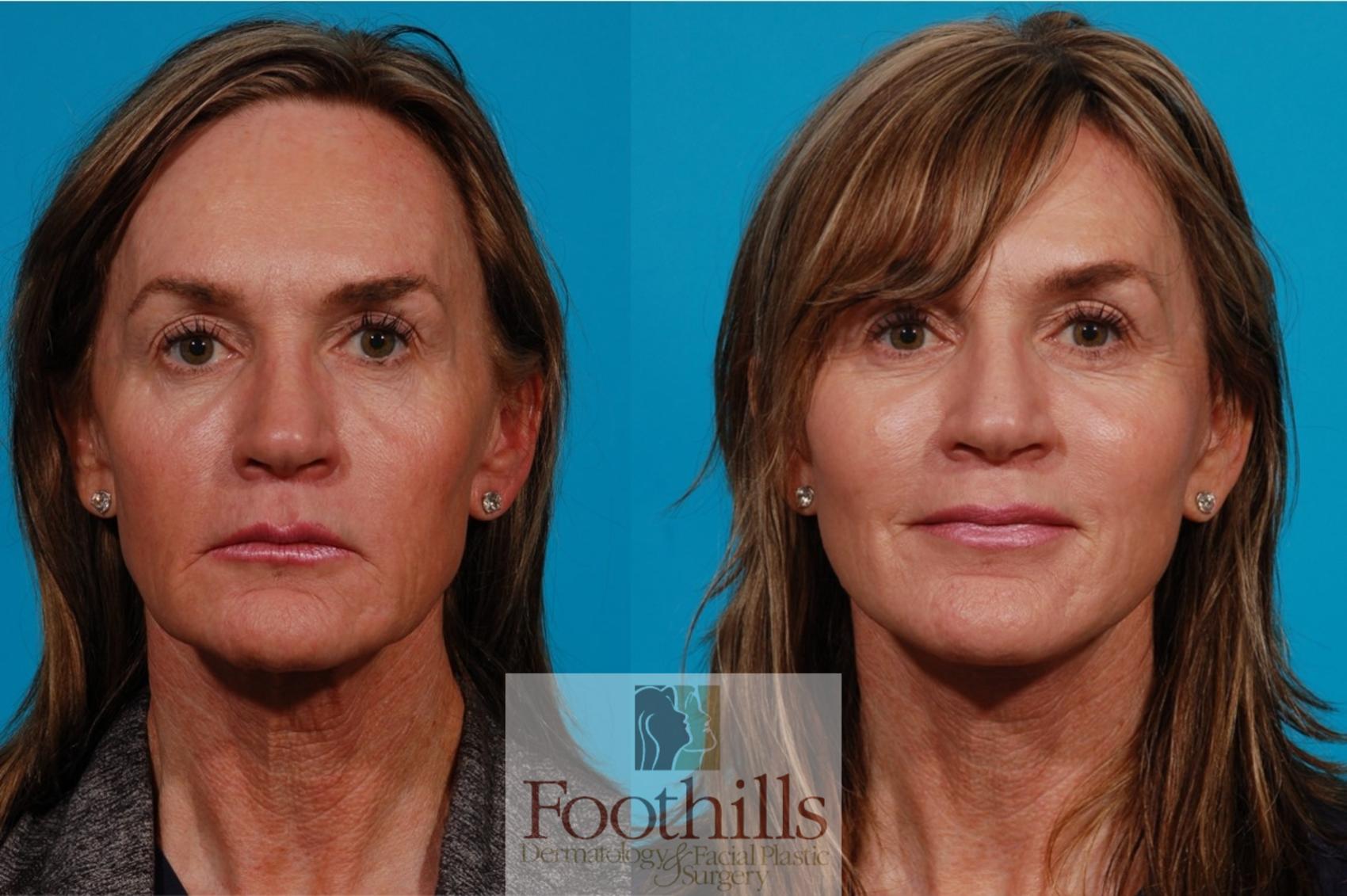 Facelift Case 143 Before & After Front | Tucson, AZ | Foothills Facial Plastic Surgery