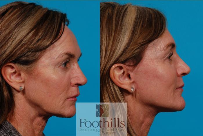 Facelift Case 143 Before & After Left Side | Tucson, AZ | Foothills Facial Plastic Surgery