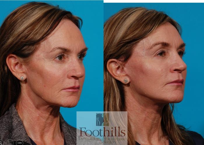 Facelift Case 143 Before & After Right Oblique | Tucson, AZ | Foothills Facial Plastic Surgery