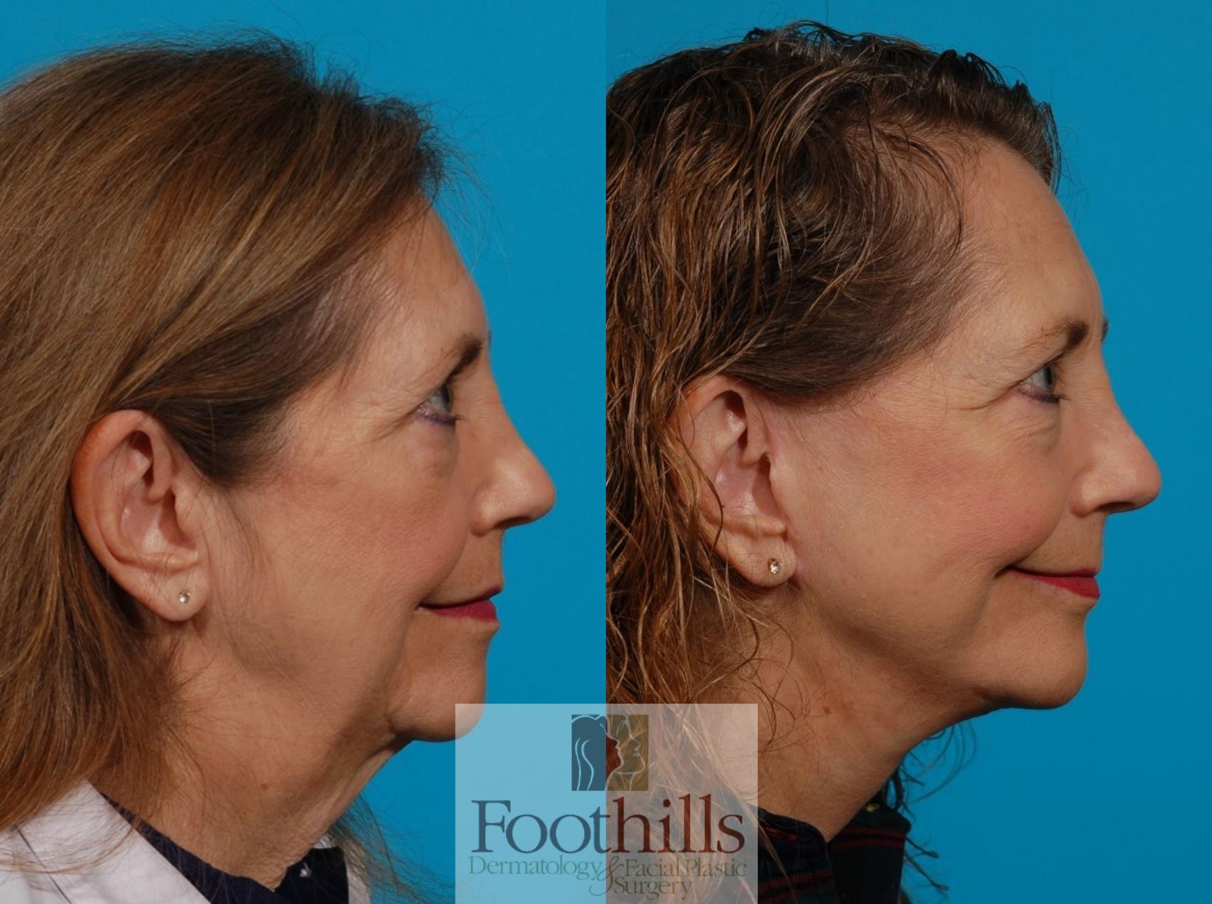 Foothills Dermatology & Facial Plastic Surgery