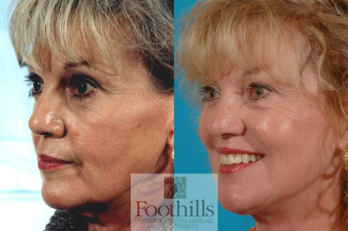 Facelift Case 16 Before & After View #2 | Tucson, AZ | Foothills Facial Plastic Surgery