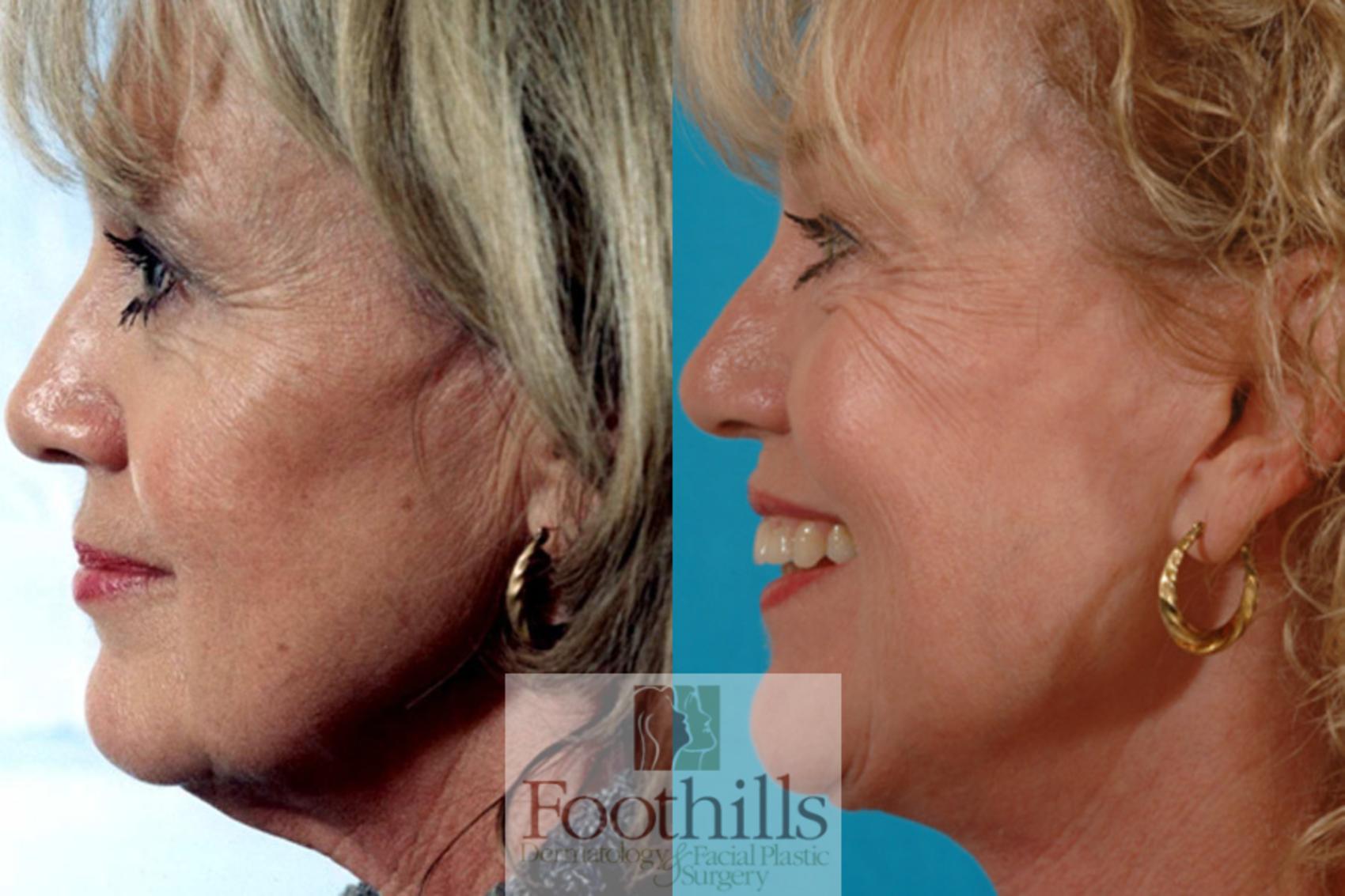 Facelift Case 16 Before & After View #3 | Tucson, AZ | Foothills Facial Plastic Surgery