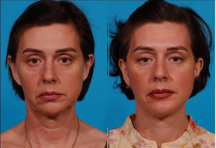 Facelift Case 168 Before & After Front | Tucson, AZ | Foothills Facial Plastic Surgery