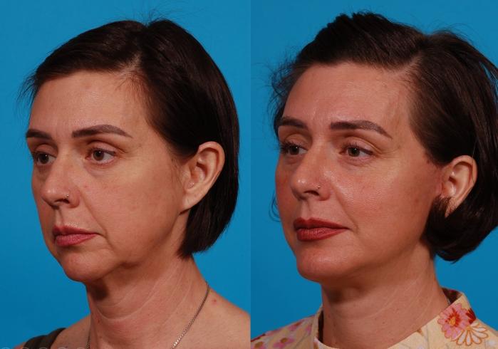 Facelift Case 168 Before & After Left Oblique | Tucson, AZ | Foothills Facial Plastic Surgery