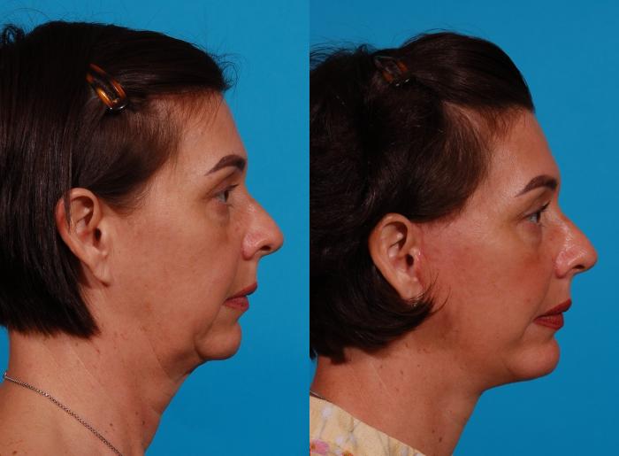 Facelift Case 168 Before & After Right Side | Tucson, AZ | Foothills Facial Plastic Surgery