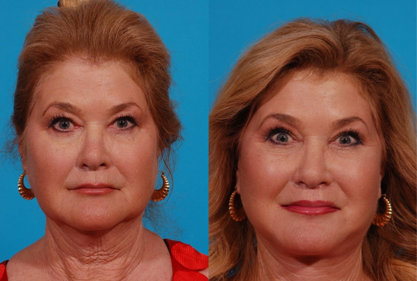 Facelift Case 169 Before & After Front | Tucson, AZ | Foothills Facial Plastic Surgery