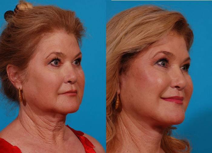 Facelift Case 169 Before & After Right Oblique | Tucson, AZ | Foothills Facial Plastic Surgery
