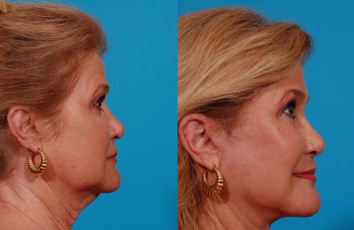 Facelift Case 169 Before & After Right Side | Tucson, AZ | Foothills Facial Plastic Surgery