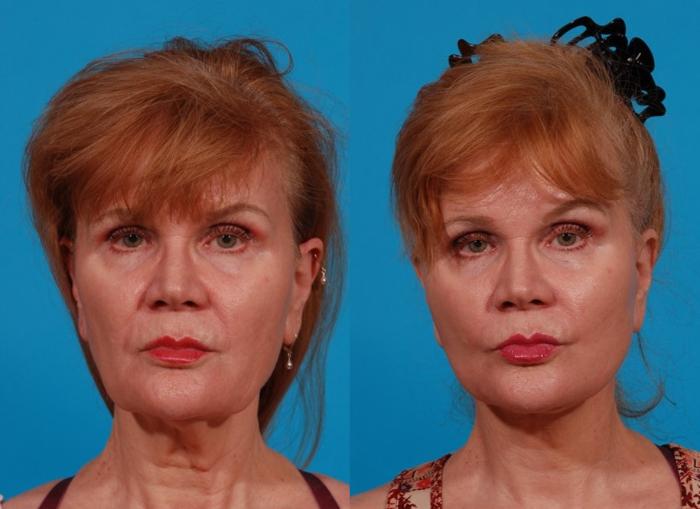Facelift Case 173 Before & After Front | Tucson, AZ | Foothills Facial Plastic Surgery