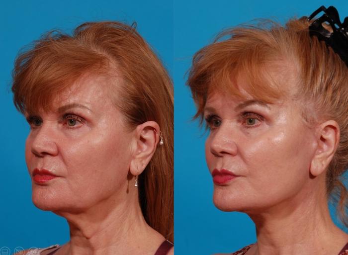 Facelift Case 173 Before & After Left Oblique | Tucson, AZ | Foothills Facial Plastic Surgery