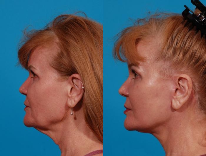 Facelift Case 173 Before & After Left Side | Tucson, AZ | Foothills Facial Plastic Surgery