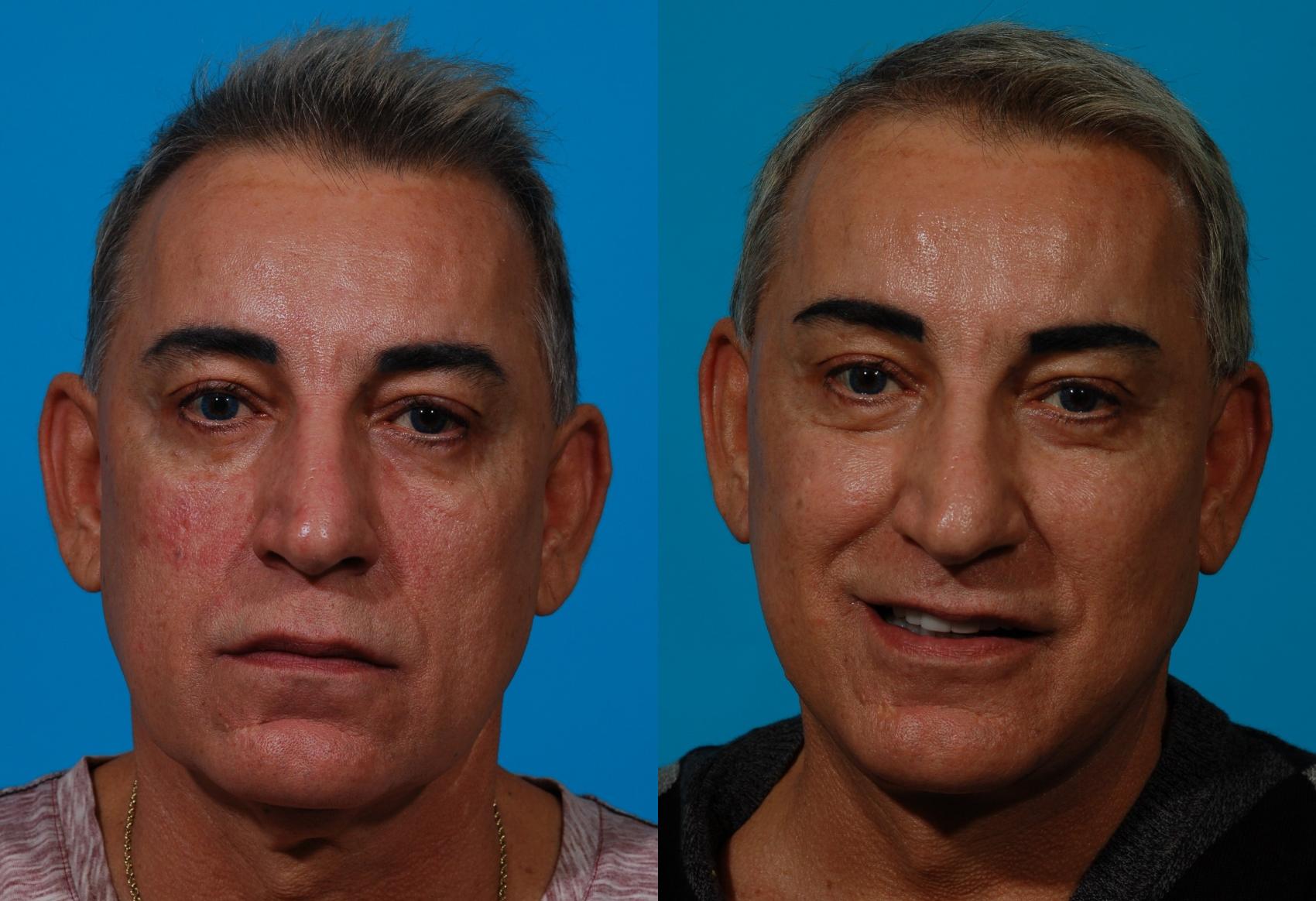 Foothills Dermatology & Facial Plastic Surgery Facelift Before & After Photos Patient 189 | Tucson, AZ | Foothills