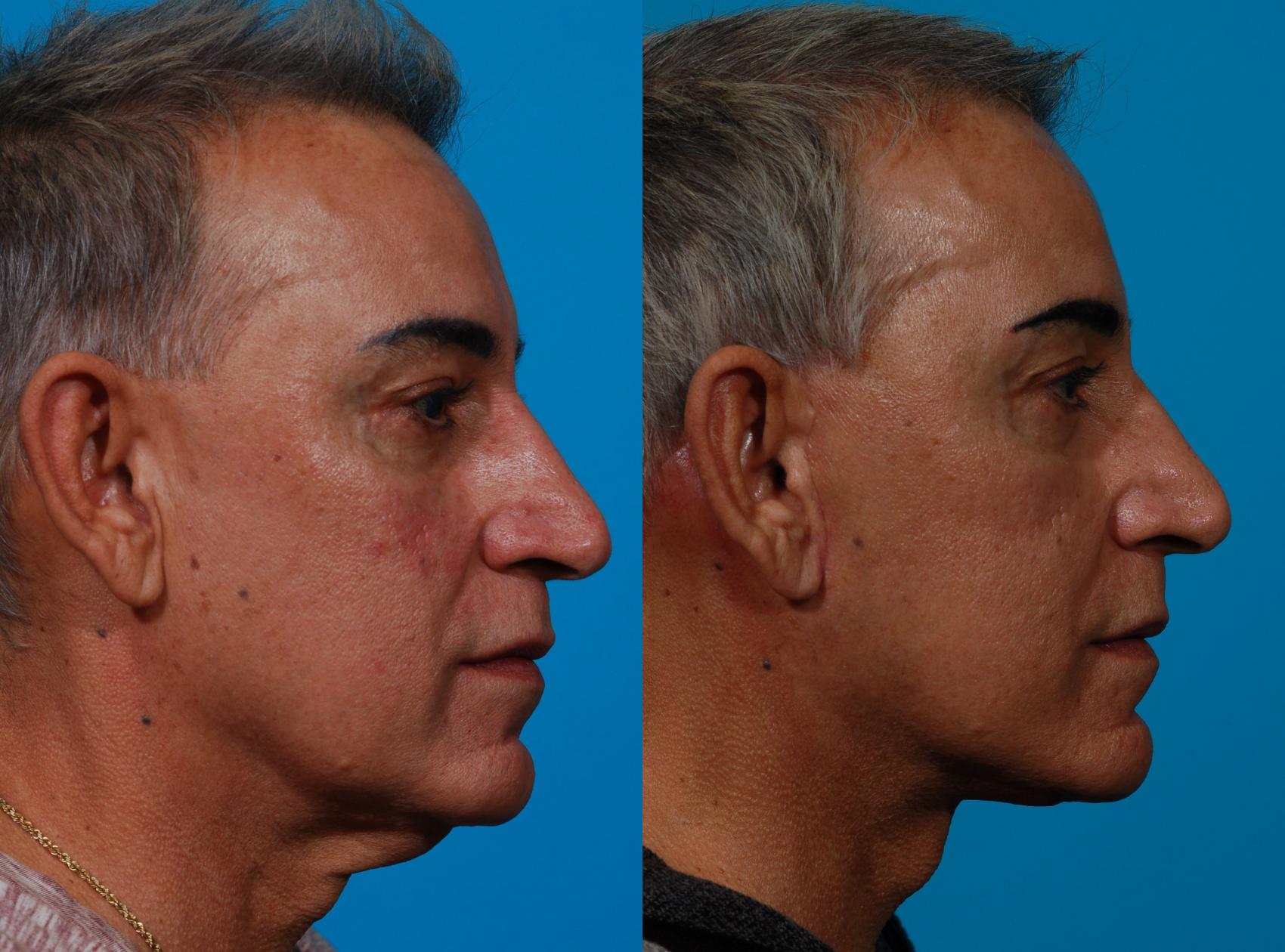 Facelift Case 189 Before & After Right Side | Tucson, AZ | Foothills Facial Plastic Surgery