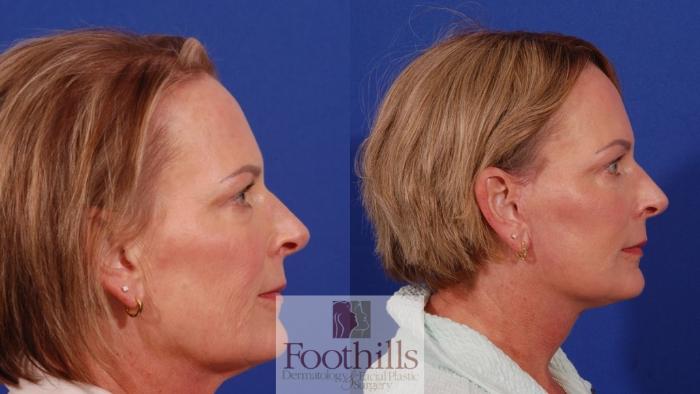 Facelift Case 191 Before & After Right Side | Tucson, AZ | Foothills Facial Plastic Surgery