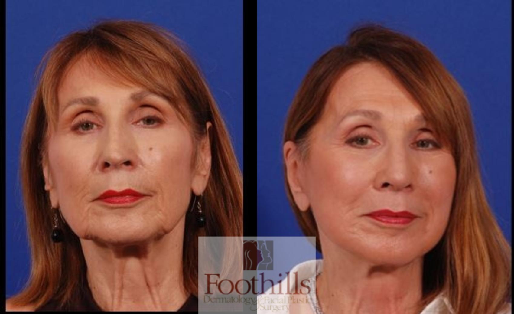 Facelift Case 192 Before & After Front | Tucson, AZ | Foothills Facial Plastic Surgery