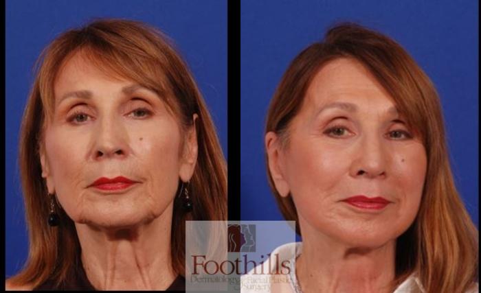 Facelift Case 193 Before & After Front | Tucson, AZ | Foothills Facial Plastic Surgery