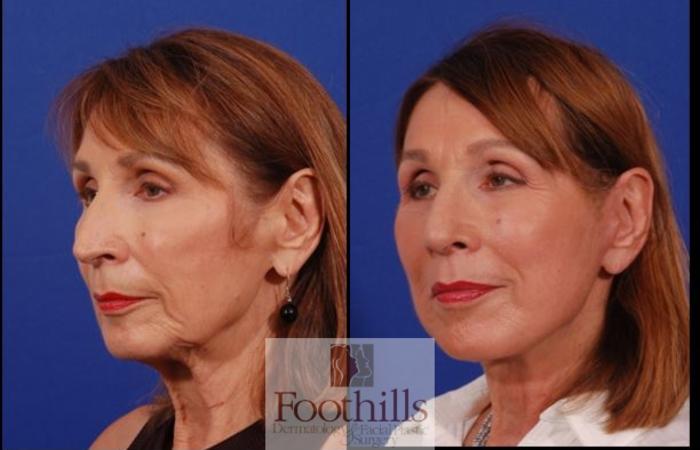 Facelift Case 193 Before & After Left Oblique | Tucson, AZ | Foothills Facial Plastic Surgery