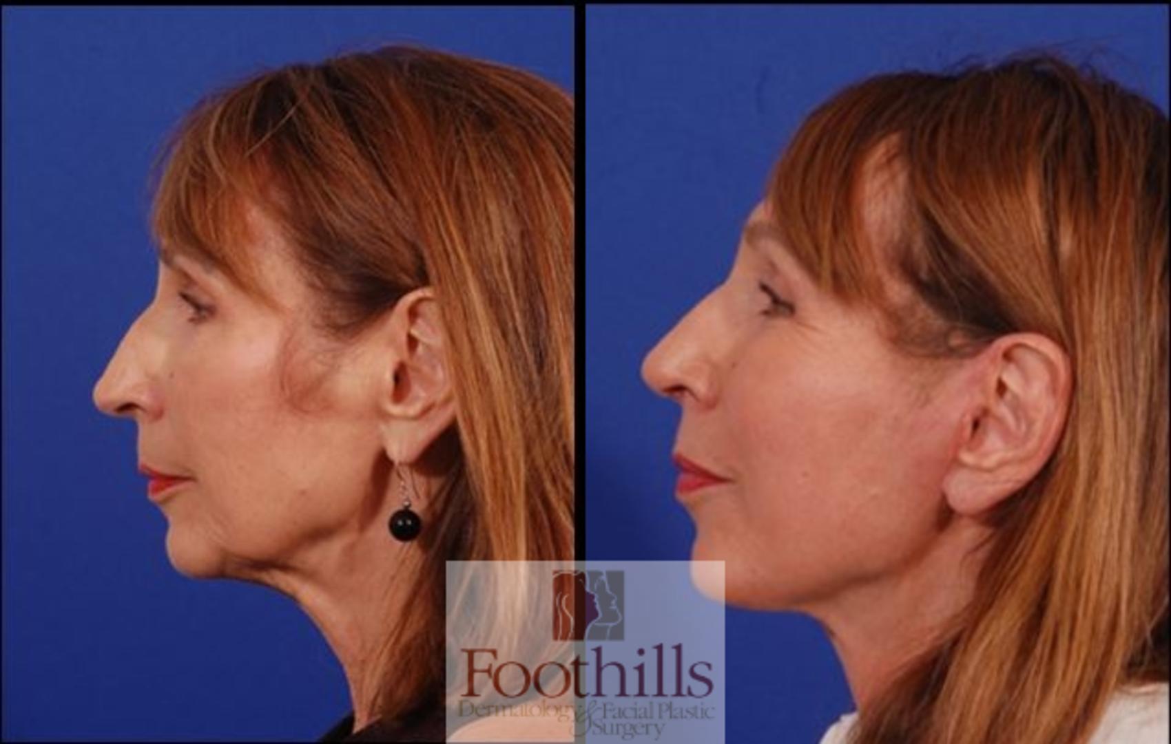 Facelift Case 193 Before & After Left Side | Tucson, AZ | Foothills Facial Plastic Surgery