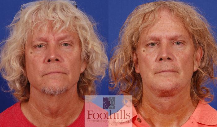 Facelift Case 195 Before & After Front | Tucson, AZ | Foothills Facial Plastic Surgery