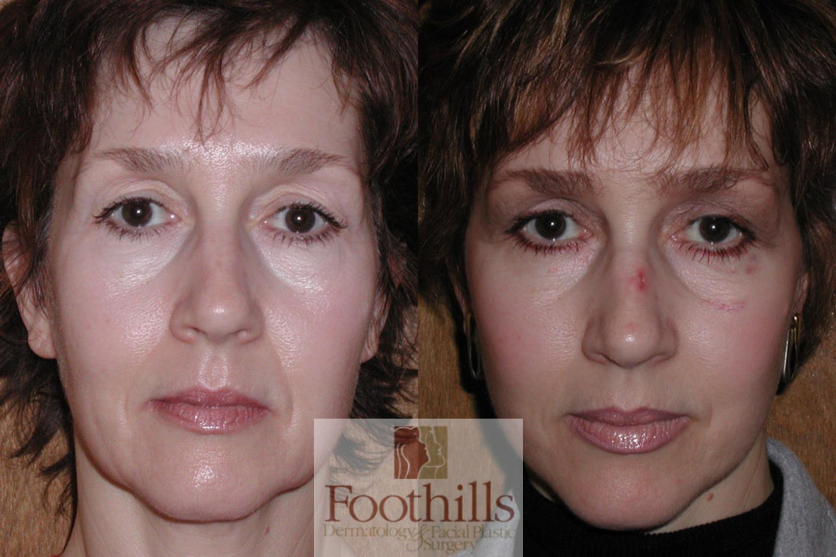 Facelift Case 2 Before & After View #1 | Tucson, AZ | Foothills Facial Plastic Surgery