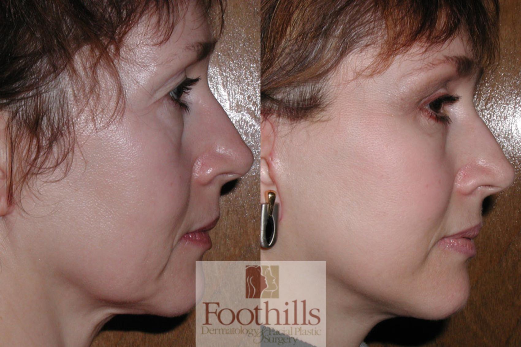 Facelift Case 2 Before & After View #2 | Tucson, AZ | Foothills Facial Plastic Surgery