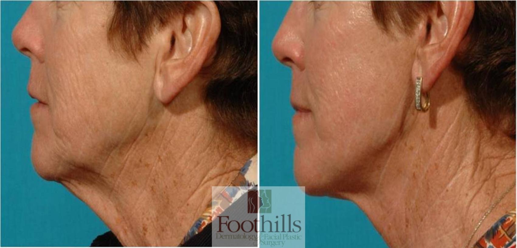 Facelift Case 70 Before & After View #1 | Tucson, AZ | Foothills Facial Plastic Surgery
