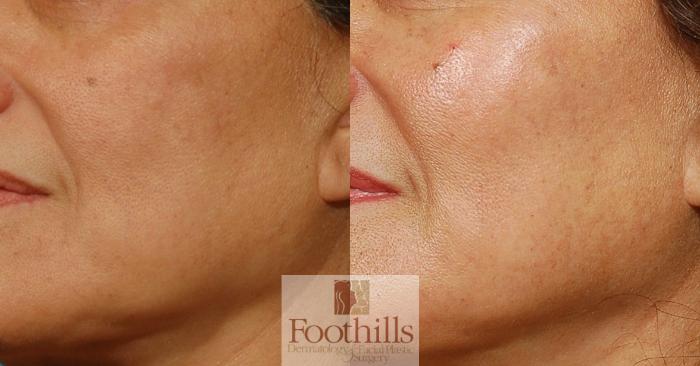 Fat Transfer Case 21 Before & After View #1 | Tucson, AZ | Foothills Facial Plastic Surgery