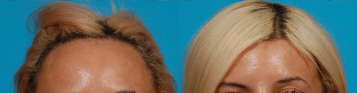Hairline Advancement Case 133 Before & After View #1 | Tucson, AZ | Foothills Facial Plastic Surgery