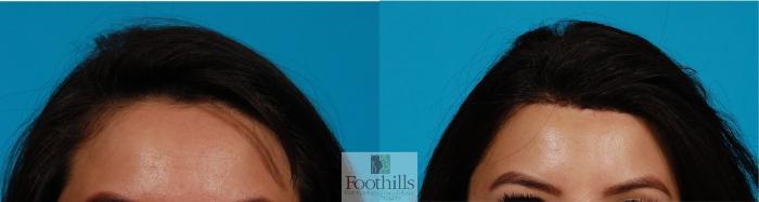 Hairline Advancement Case 145 Before & After Front | Tucson, AZ | Foothills Facial Plastic Surgery