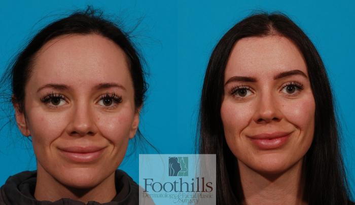 Hairline Advancement Case 152 Before & After Front | Tucson, AZ | Foothills Facial Plastic Surgery