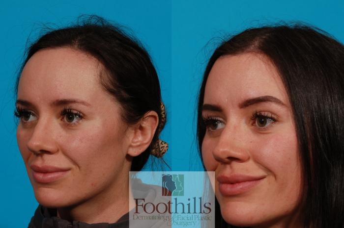 Hairline Advancement Case 152 Before & After Left Oblique | Tucson, AZ | Foothills Facial Plastic Surgery