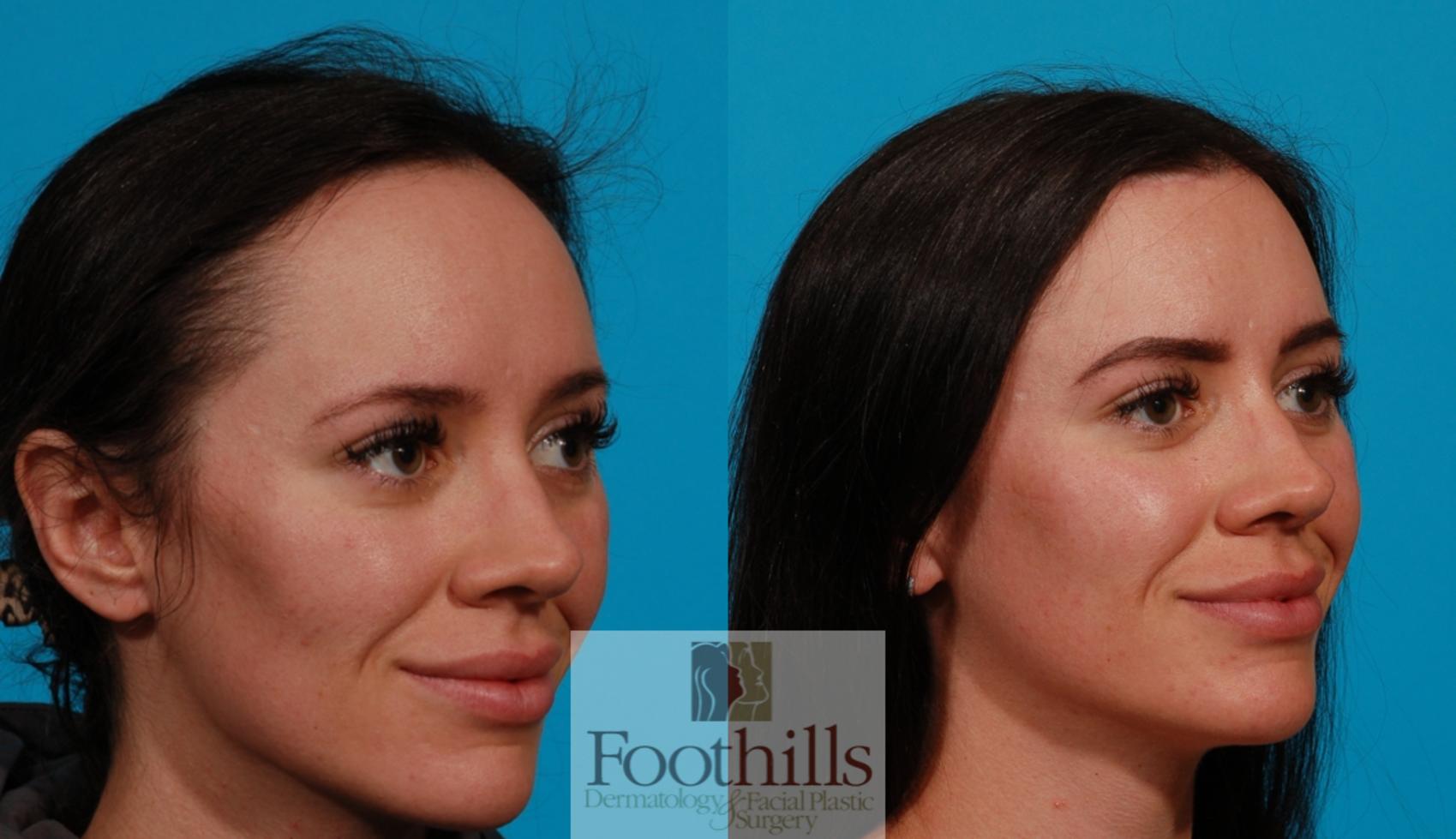 Hairline Advancement Case 152 Before & After Right Oblique | Tucson, AZ | Foothills Facial Plastic Surgery