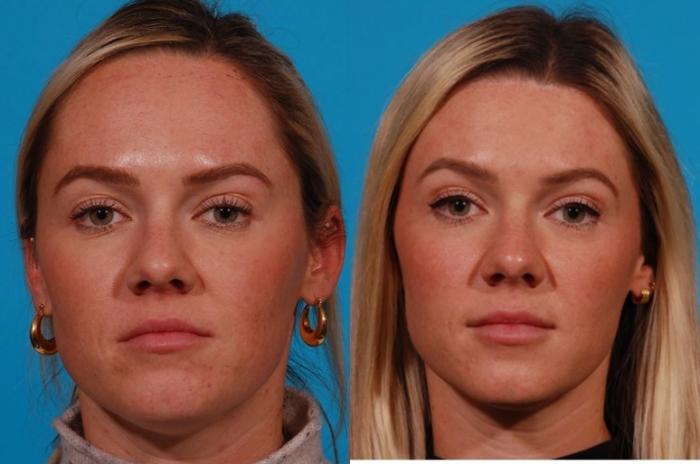Hairline Advancement Case 171 Before & After Front | Tucson, AZ | Foothills Facial Plastic Surgery
