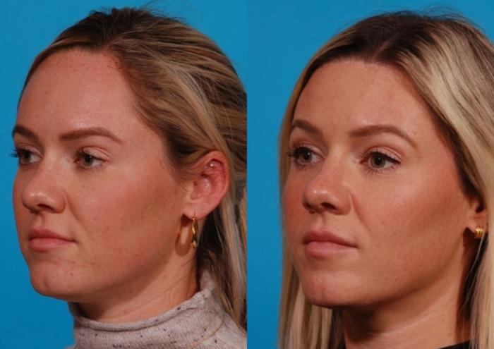 Hairline Advancement Case 171 Before & After Left Oblique | Tucson, AZ | Foothills Facial Plastic Surgery