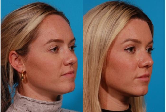 Hairline Advancement Case 171 Before & After Right Oblique | Tucson, AZ | Foothills Facial Plastic Surgery