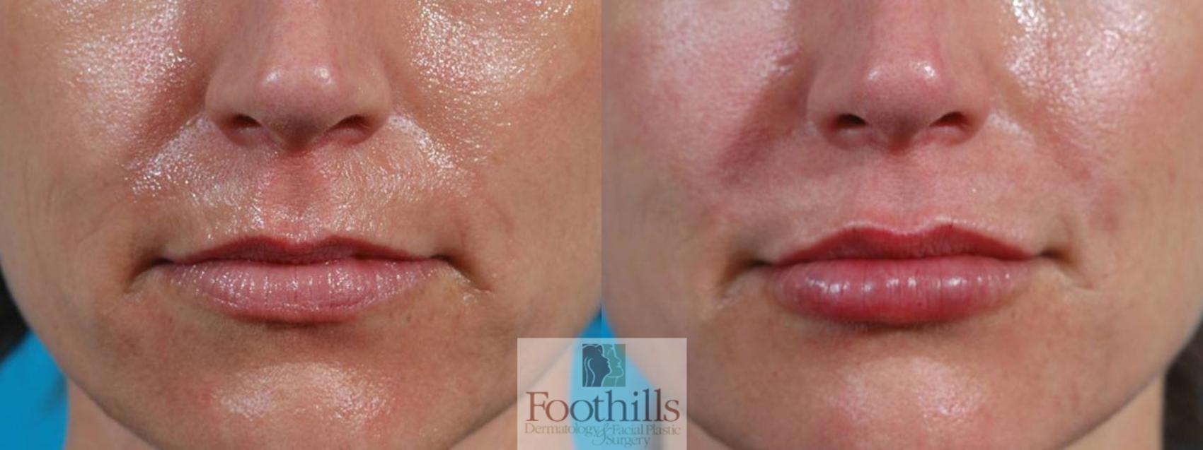 Injectable Fillers Case 4 Before & After View #1 | Tucson, AZ | Foothills Facial Plastic Surgery