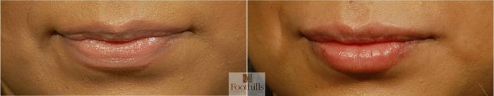 Injectable Fillers Case 51 Before & After View #1 | Tucson, AZ | Foothills Facial Plastic Surgery