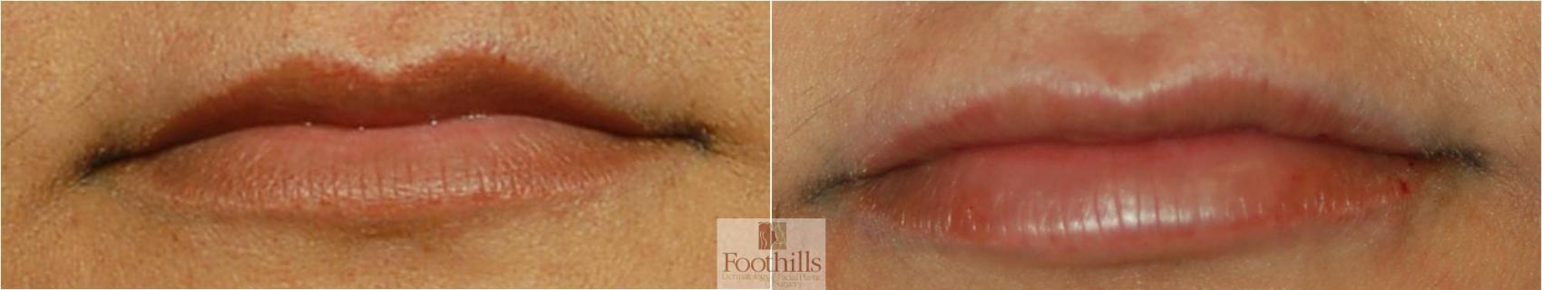 Injectable Fillers Case 64 Before & After View #1 | Tucson, AZ | Foothills Facial Plastic Surgery
